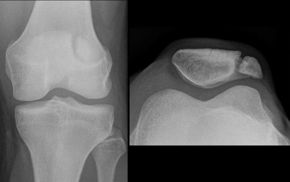 Bipartite Patella Xray Radrounds Radiology Network