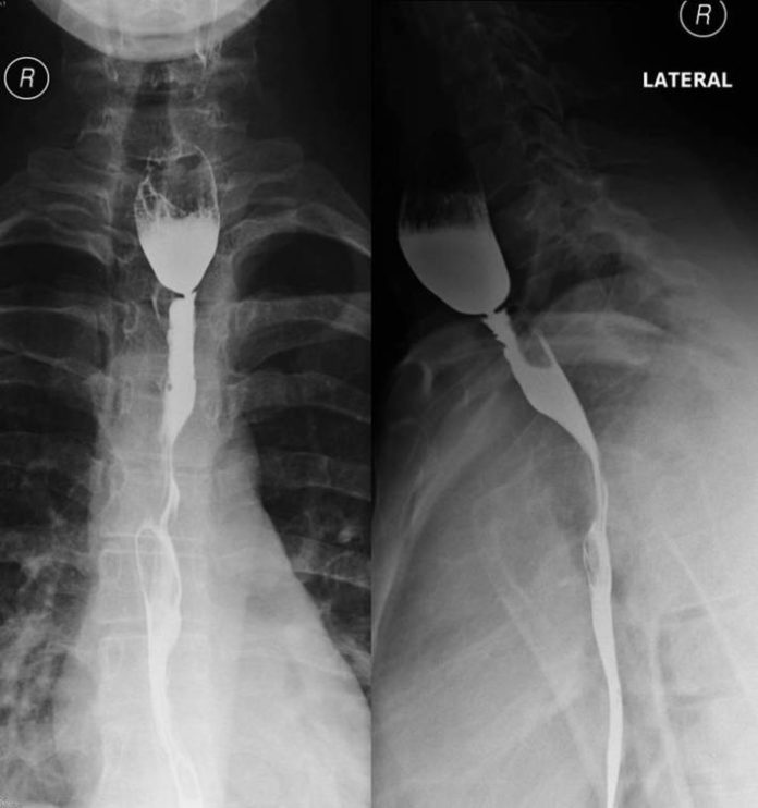 Oesophageal Web RadRounds Radiology Network