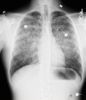 Non Cardiogenic Pulmonary Edema Radrounds Radiology Network