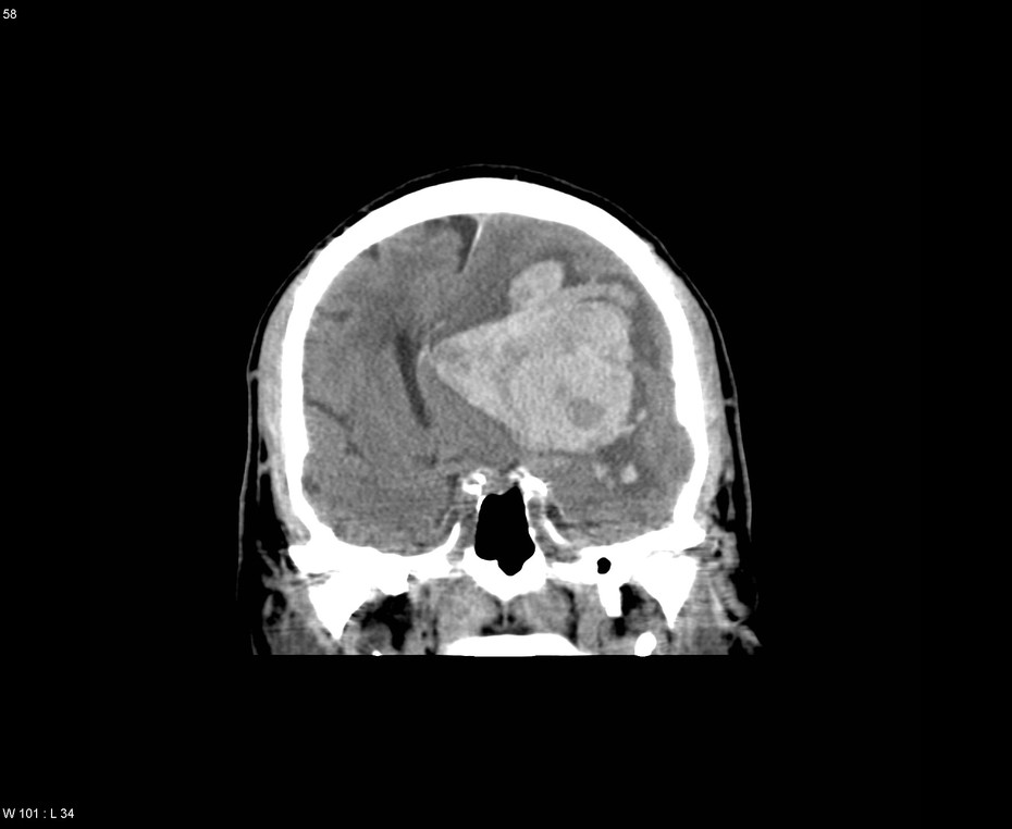 Large Intracranial Hemorrhage Ct Radrounds Radiology Network