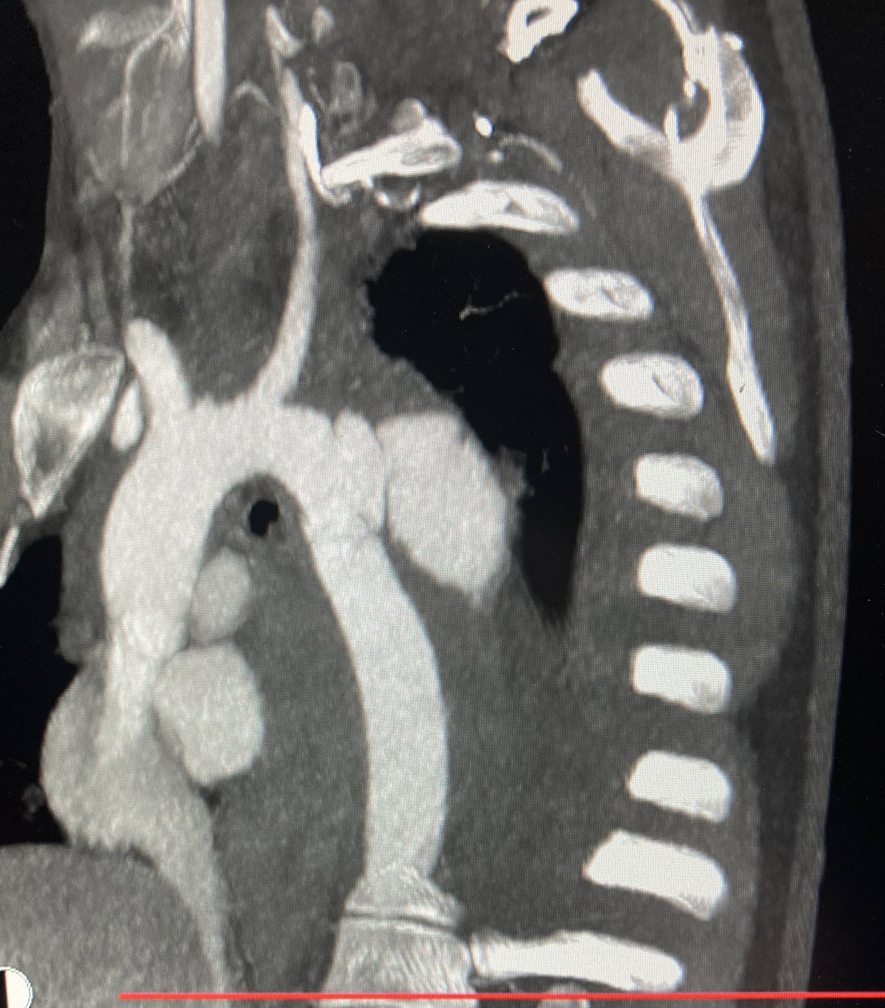 Traumatic Aortic Injury Radrounds Radiology Network