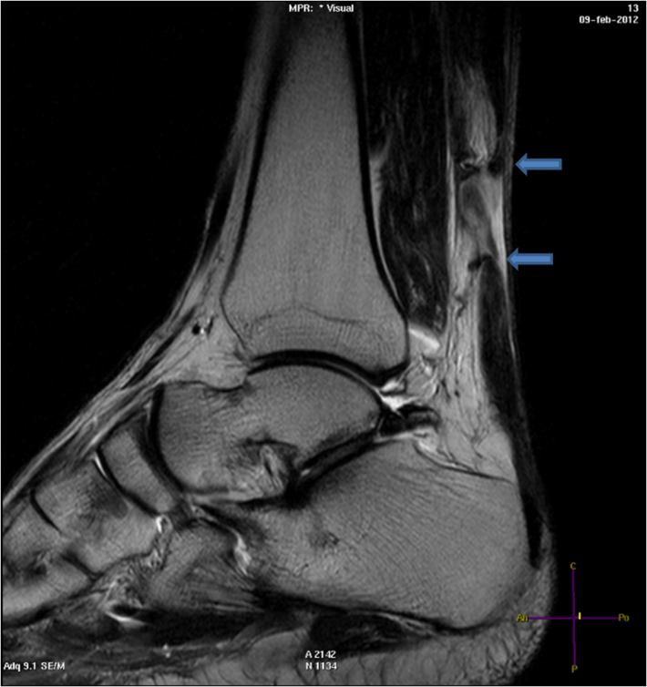 Complete Achilles Rupture (MRI) - radRounds Radiology Network