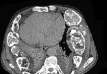 Fibrous Dysplasia (CT)