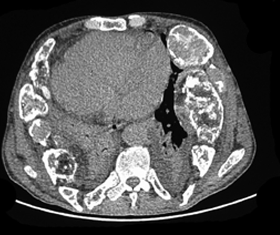 Fibrous Dysplasia (CT) - radRounds Radiology Network