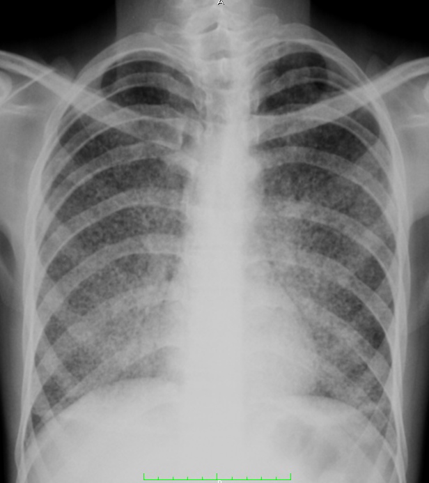 Miliary Tuberculosis (X-Ray) - radRounds Radiology Network