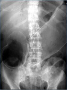 Rigler sign (X-Ray) - radRounds Radiology Network