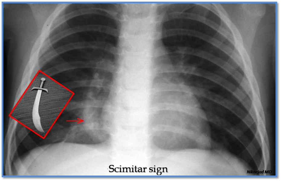 Scimitar sign - radRounds Radiology Network