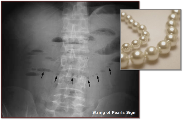 String Of Pearls Sign X Ray Radrounds Radiology Network