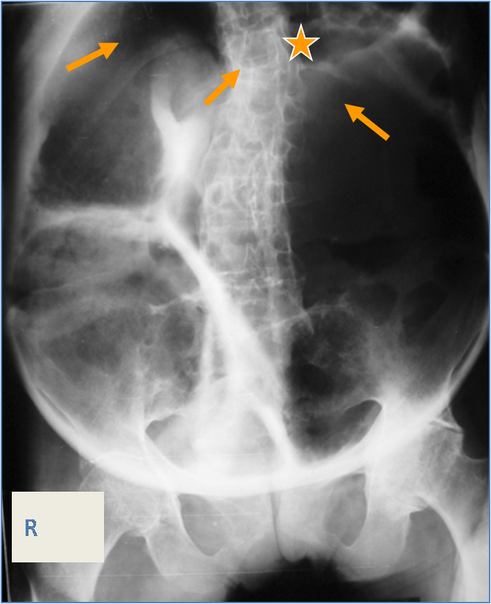 Volvulus Transverse Colon Radrounds Radiology Network