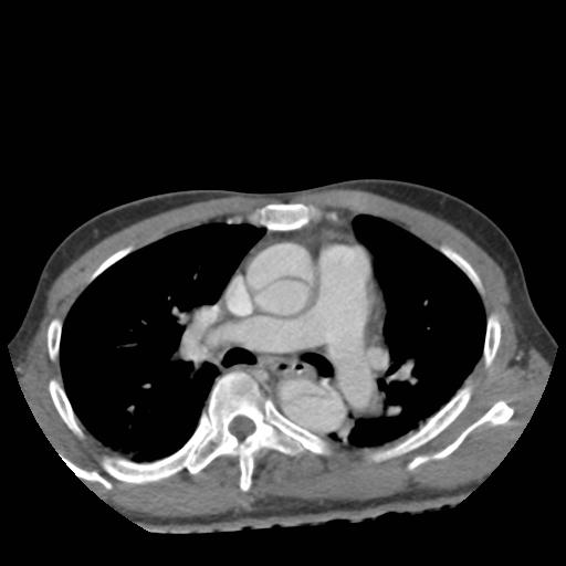 Angio CT showing Aortic Dissection - radRounds Radiology Network