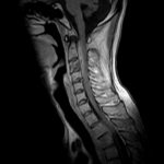 Arachnoiditis