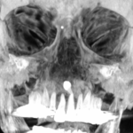 Inverted Supernumerary Tooth