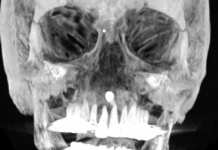 Inverted Supernumerary Tooth