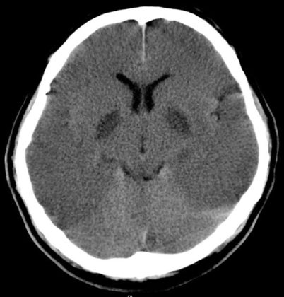 Hypoxic Brain Injury - radRounds Radiology Network