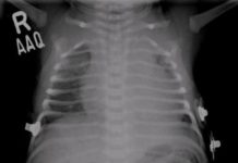 Necrotizing enterocolitis (NEC) – KUB