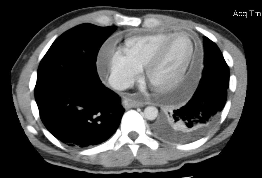 Pericarditis - radRounds Radiology Network