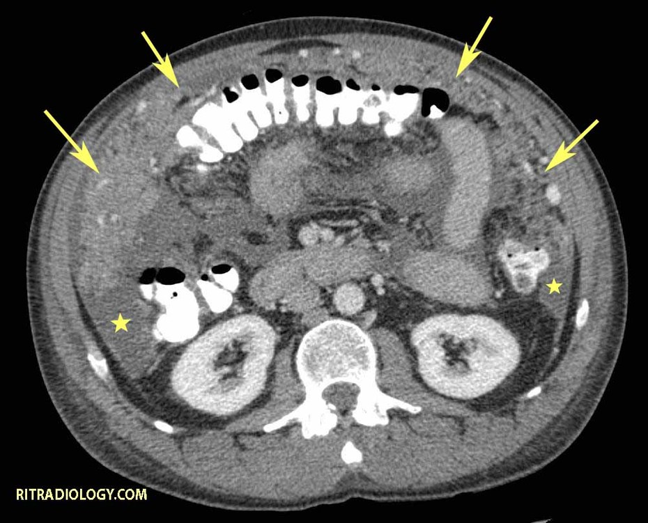 Peritoneal Sarcomatosis - radRounds Radiology Network