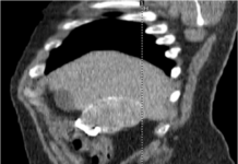 Retained Surgical Sponge – Gossypiboma