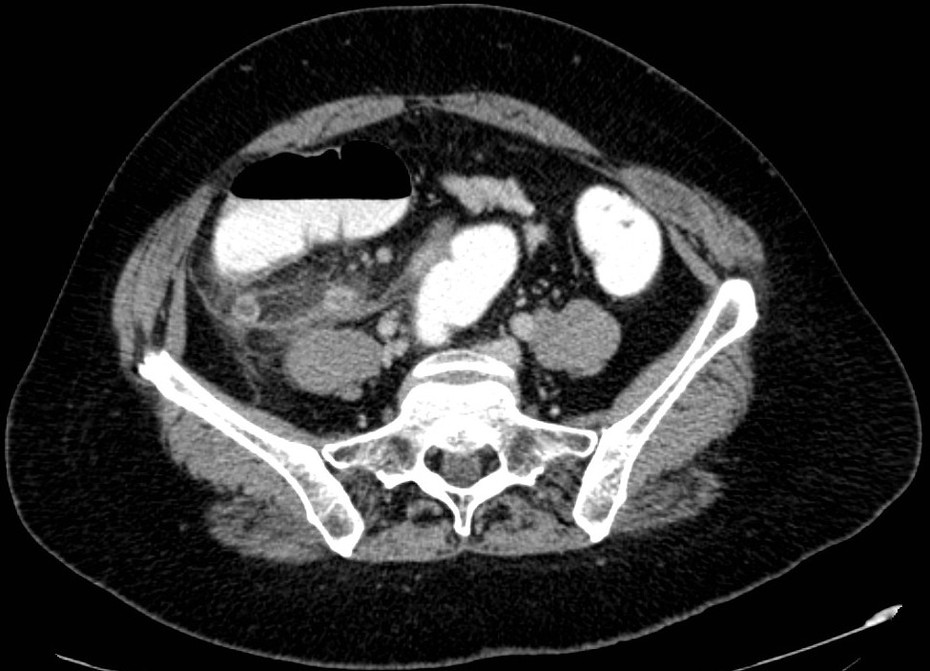 Appendicitis on CT - radRounds Radiology Network