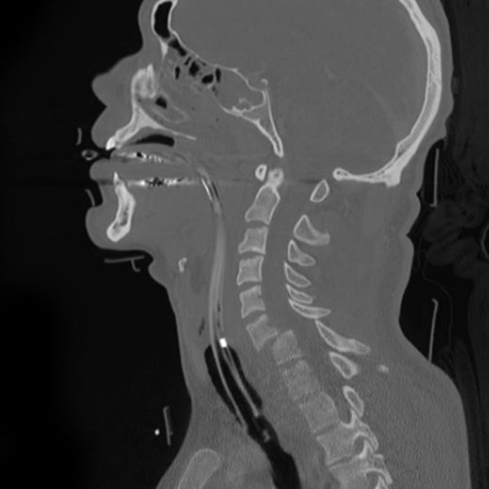 snow-mobile-accident-cervical-spine-dislocation-radrounds-radiology