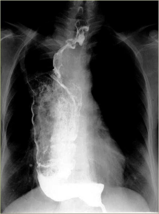 Esophageal Cancer In Achalasia - RadRounds Radiology Network