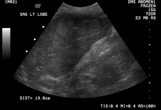 Normal Liver Size On Ultrasound RadRounds Radiology Network