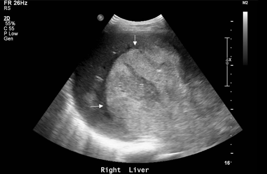 large-hepatocellular-carcinoma-on-ultrasound-radrounds-radiology-network