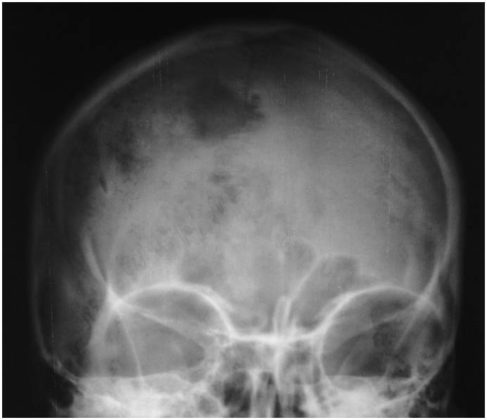 Osteomyelitis of the frontal bone - radRounds Radiology Network