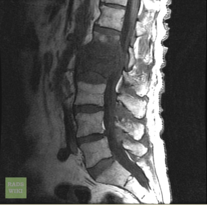 Discitis Osteomyelitis Of Lumbar Spine (MRI) - RadRounds Radiology Network