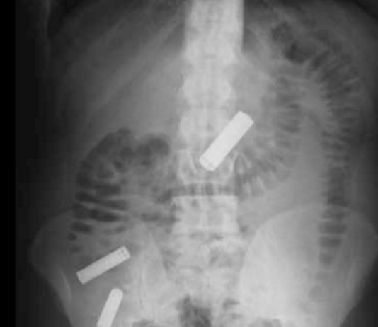 Abdominal X-Ray: Foreign Bodies - radRounds Radiology Network