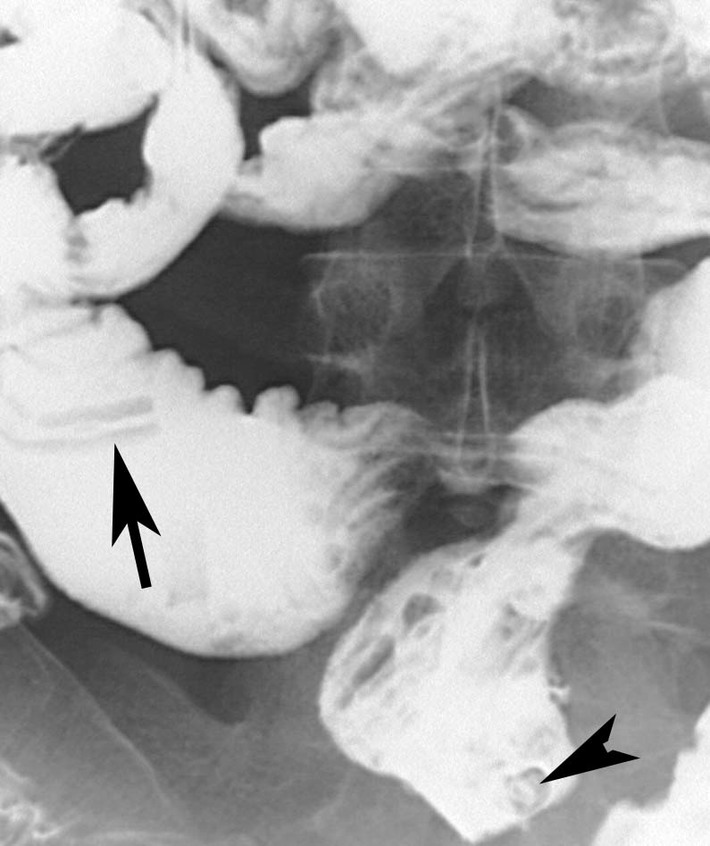 Intestinal Ascariasis Radrounds Radiology Network