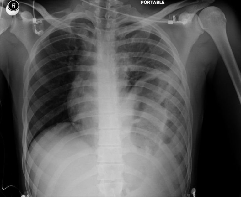 Diaphragmatic rupture radRounds Radiology Network