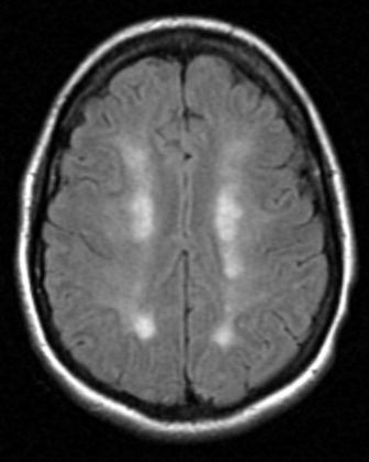 Internal Watershed Infarct - radRounds Radiology Network