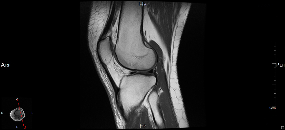 Deep Learning Helps Accelerate MRI Knee Exam Interpretation - radRounds ...