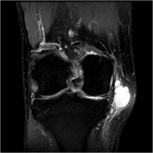 Pes Anserine Bursitis - RadRounds Radiology Network