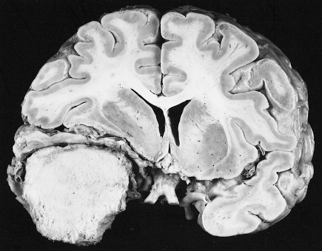 MRI Helps Us Distinguish Benign from Malignant Meningioma - radRounds ...