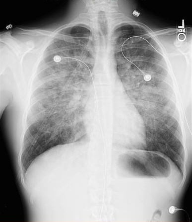 Pulmonary Edema Radiology