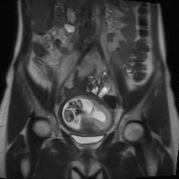 appendicitis-in-pregnancy-mri-radrounds-radiology-network