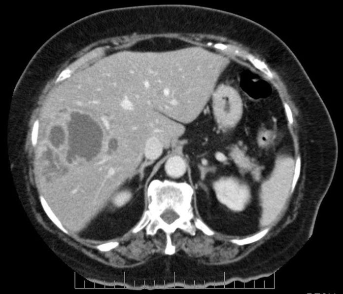 Hepatic Pyogenic Abscess radRounds Radiology Network