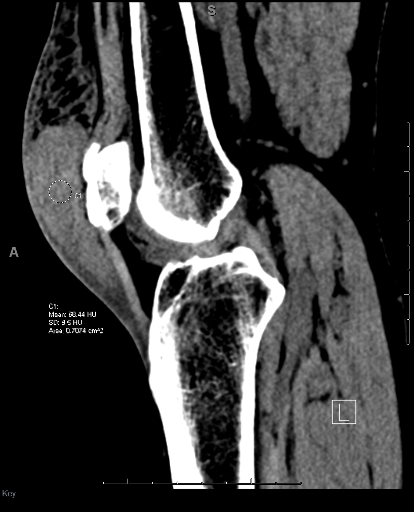 Hemorrhagic Pre-patellar bursitis - radRounds Radiology Network