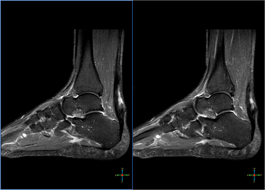 partial-tears-of-achilles-tendon-radrounds-radiology-network