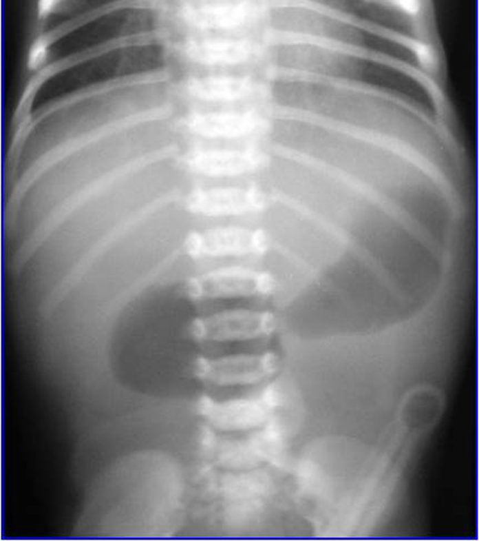 Duodenal Atresia (Double Bubble Sign on X-Ray) - radRounds Radiology ...