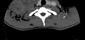 Rhabdomyosarcoma of the right neck (CT) - radRounds Radiology Network