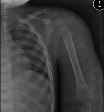 Traumatic osteomyelitis with abscess formation in triceps (X-Ray ...