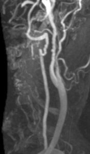 Fibromuscular Dysplasia of the Carotid Artery (MRA) - radRounds