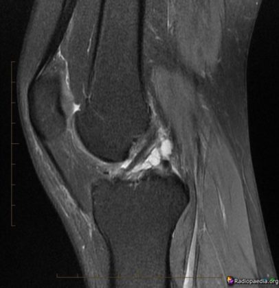 ACL Ganglion Cyst - radRounds Radiology Network