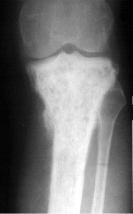 Lymphoma (X-Ray) - radRounds Radiology Network