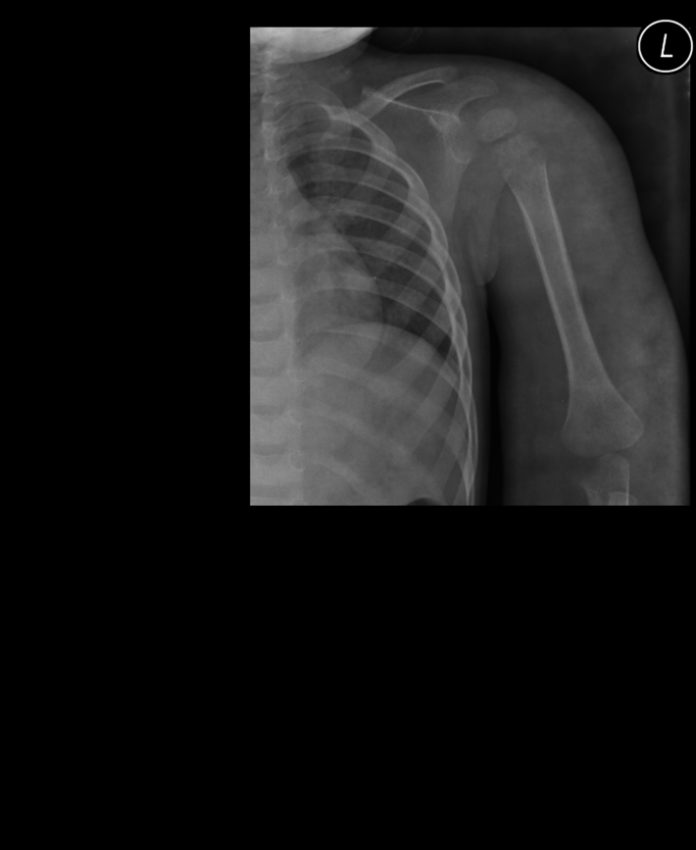 Traumatic osteomyelitis with abscess formation in triceps (X-Ray ...