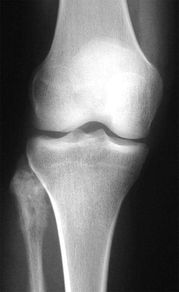 Osteosarcoma (X-Ray) - radRounds Radiology Network