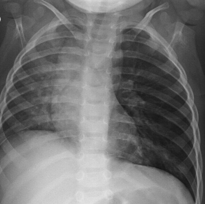 Postoperative Chest X Ray Image Showing Pneumothorax